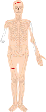 Skema over Borremosemanden. Rød = brud, beige = blødt væv, grå/hvid = knogler.