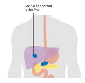 Metastaseret bugspytkirtelkræft – Stadie M1
