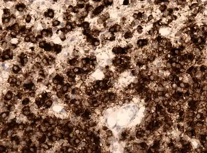 IDH1 R132H i anaplastisk oligodendrogliom