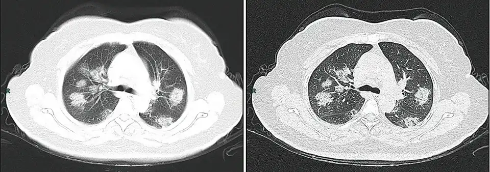 Hurtigt fremadskridende udviklingstrin('rapid progression stage')