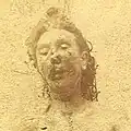 Mortuary photograph of Eddowes. Her lower face is severely mutilated