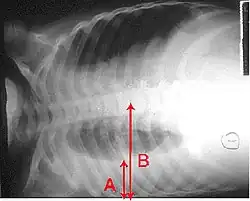 Et røntgenbillede, der viser en horisontalt liggende brystkasse. Det nederste sorte område, som er højre lunge, er mindre og har et mere hvidt område nedenunder, der er en pulmonal effusion. Røde pile angiver størrelsen på disse.
